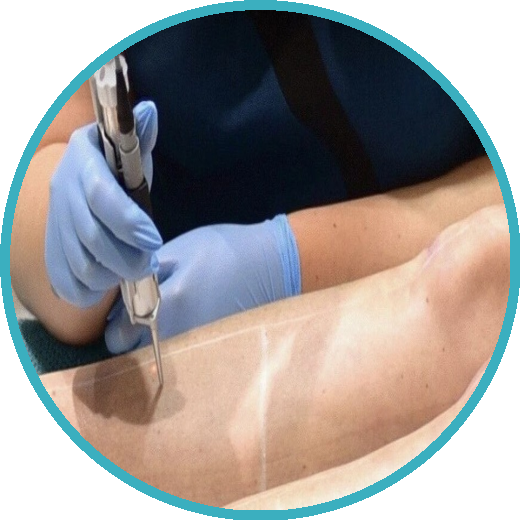 Laser Hair Removal Preston