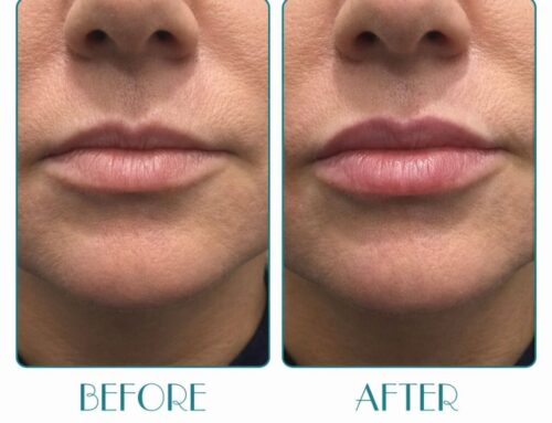Lip Filler Treatment: Natural Results with High-End Dermal Fillers